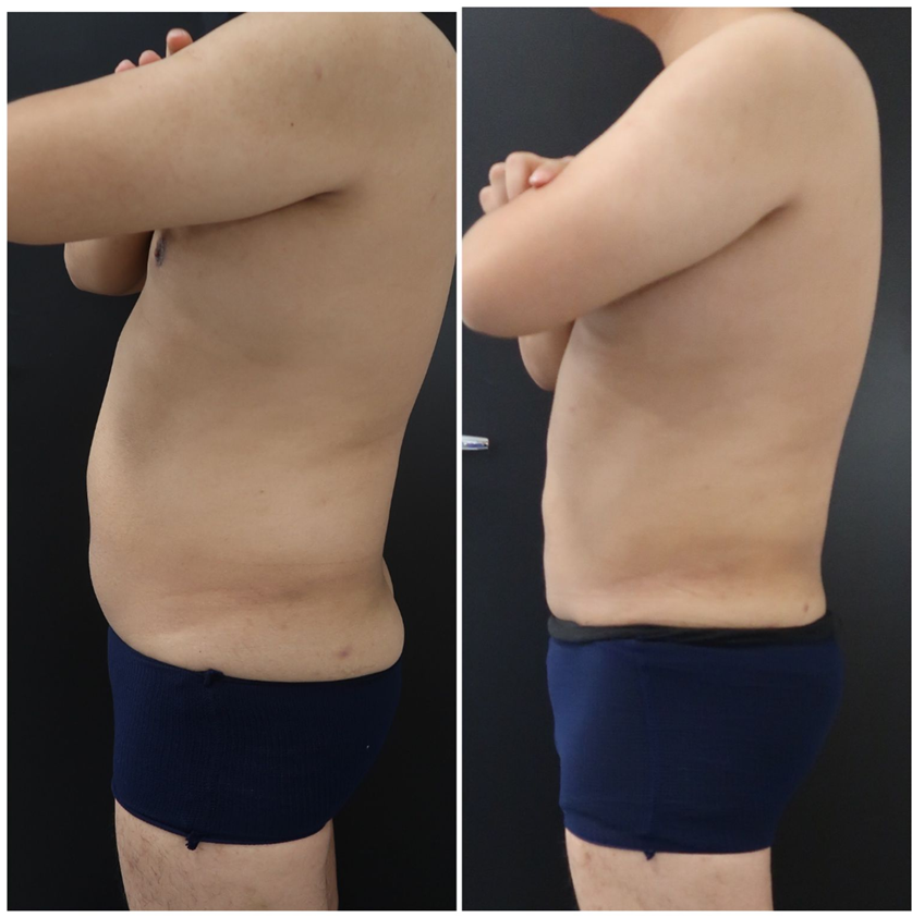 Get Rid Of Stubborn Fat With Liposuction Surgery
